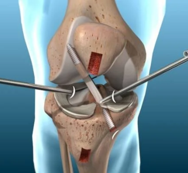 Arthroscopic Surgeries