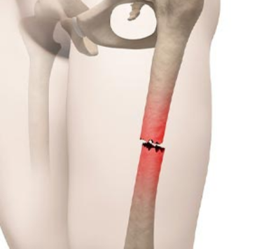 Complex Trauma
