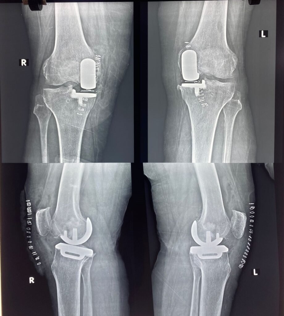 Partial vs. Total Knee Replacement: Who is the Ideal Candidate for PKR?