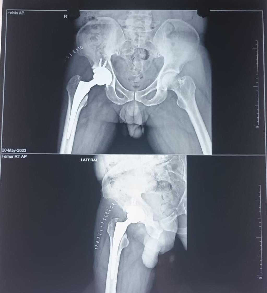 Total Hip Replacement & Avascular Necrosis (AVN): Restoring Pain-Free Hip Mobility