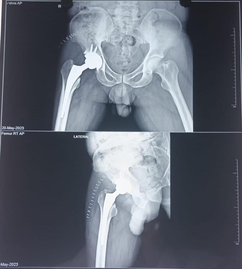 Total Hip Replacement