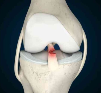 Ligament (ACL/PCL) Reconstruction Surgeries