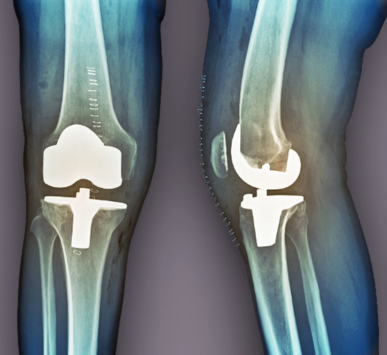 Total And Partial Knee Replacement